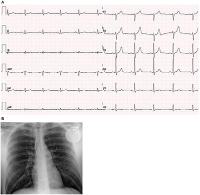 Case Report: Probable Myocarditis After Covid-19 mRNA Vaccine in a Patient With Arrhythmogenic Left Ventricular Cardiomyopathy